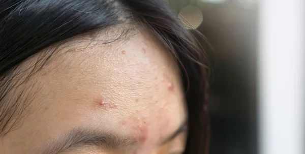 How To Reduce Pimples On Forehead?